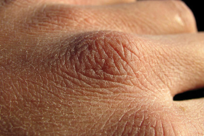 dry skin